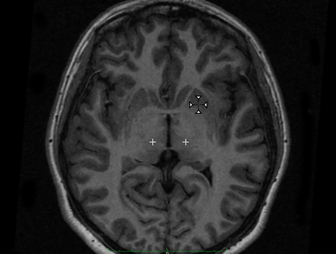 IRM d'un cerveau