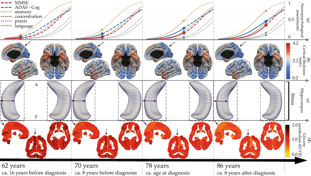 Modèles numériques personnalisables de l'évolution de la maladie d'Alzheimer.