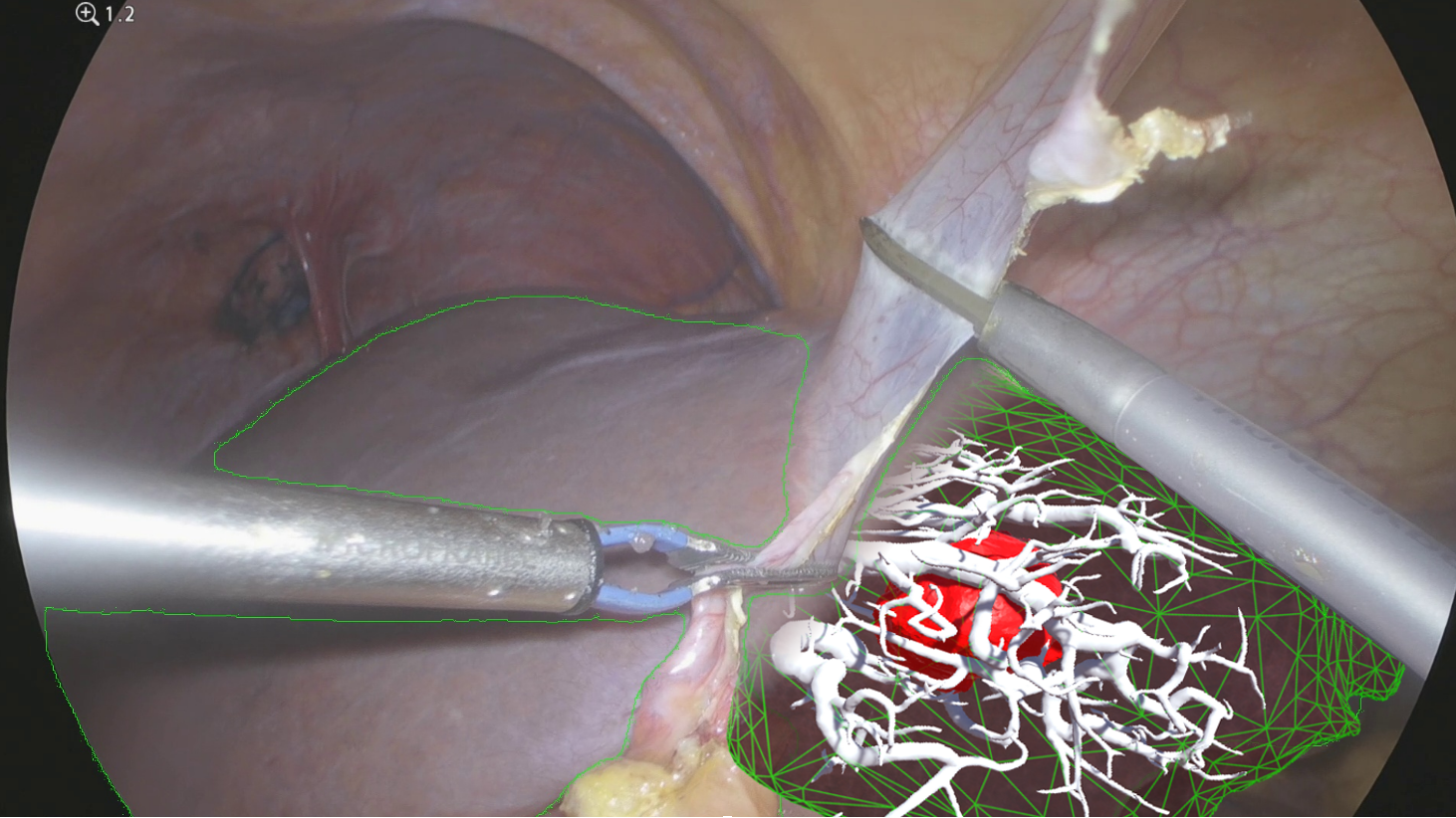 Exemple de visualisation de l'anatomie interne de foie pendant la chirurgie