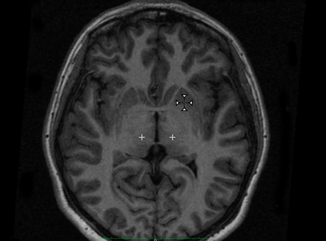Scan d'un cerveau