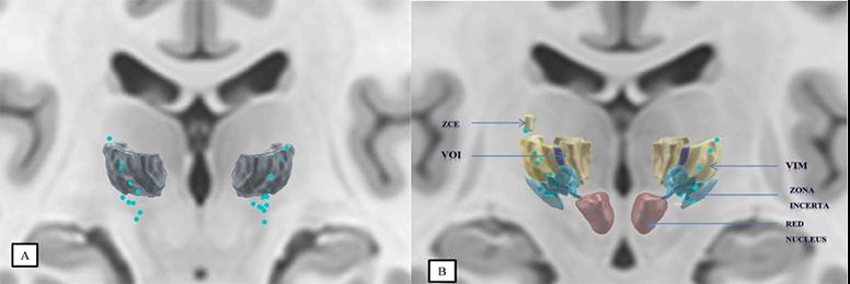 Simulation de ciblage sur l'IRM d'un cerveau avec le logiciel OptimDBS